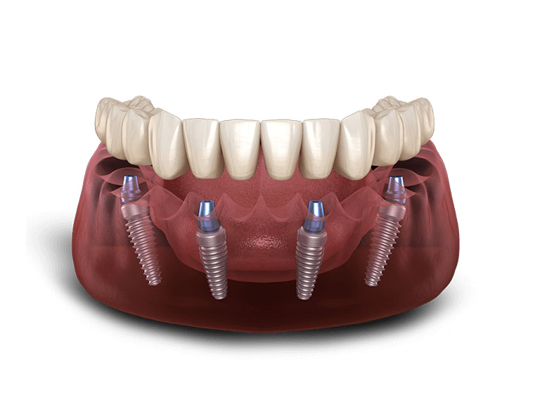 The All-On-4® Technique