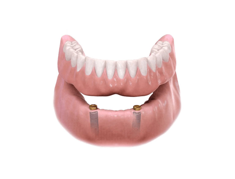 Fixed vs. Removable Implant Solutions